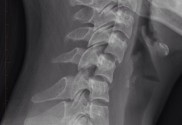 Subluxation